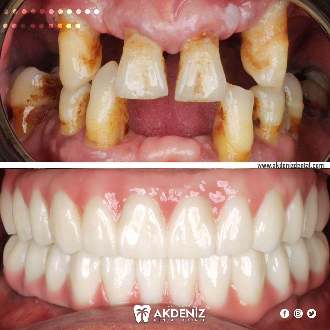 All-on-6 Dental Implants Antalya