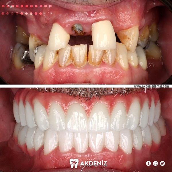 Before and After All-on-4 Dental Implants Turkey