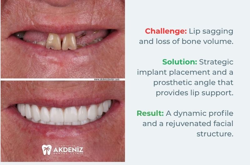 All on 4 dental implants before and after Turkey Antalya