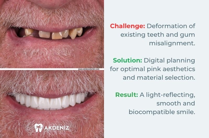 All on 4 dental implants before and after Antalya