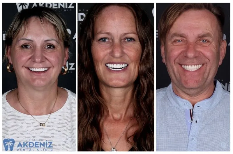 Natural-looking All on 4 dental implants in Antalya