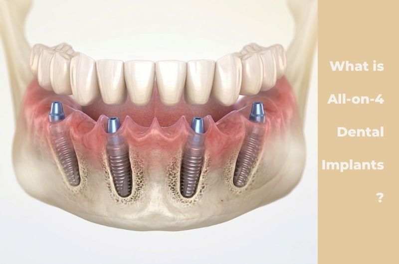 All-on-4 Dental Implants Antalya