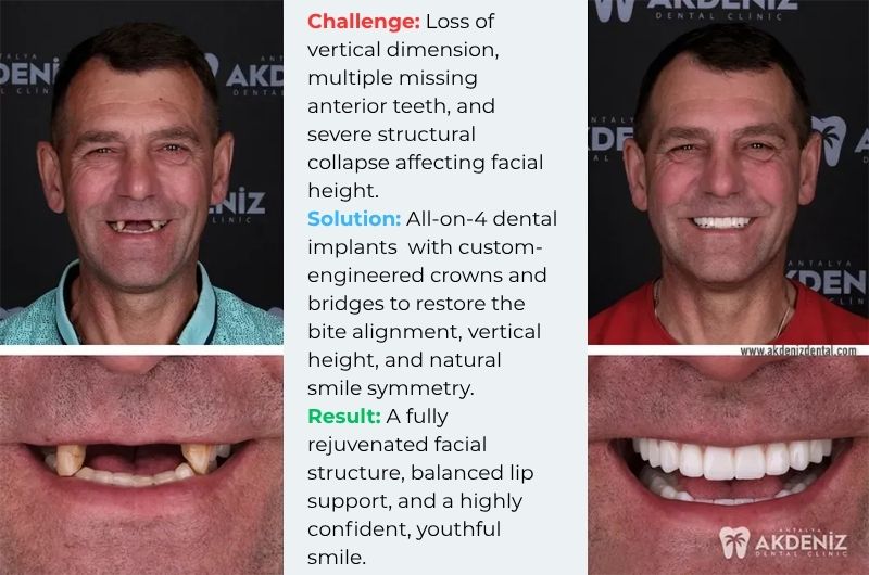 All on 4 dental implants before and after photos Antalya