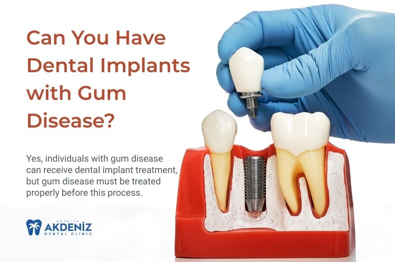 Can You Have Dental Implants with Gum Disease?