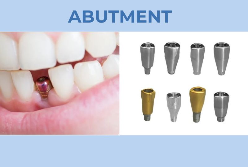 Dental Implant Abutment