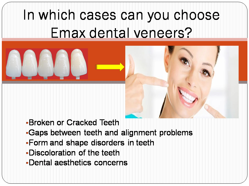 In which cases can you choose Emax dental veneers?