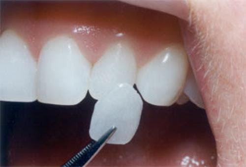 The bonding stage of e-max veneers