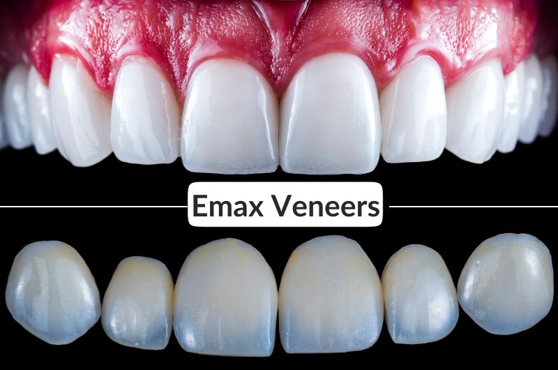 Emax Veneers