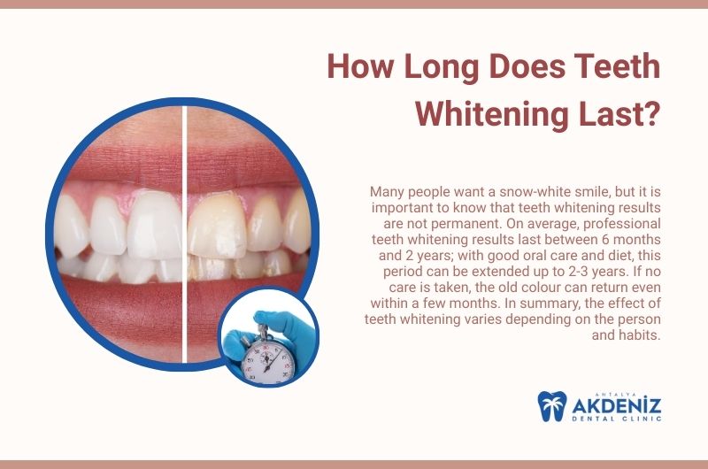 How Long Does Teeth Whitening Last?