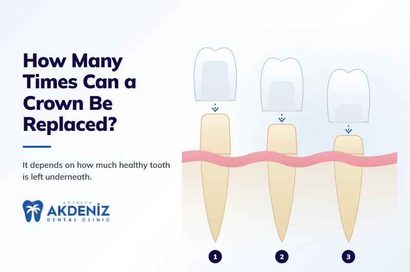How many times can a dental crown be replaced
