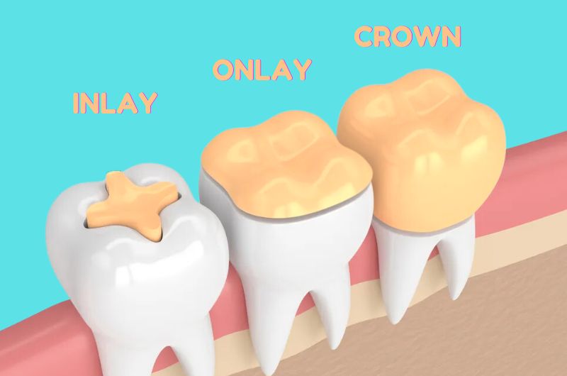 Nutrition during dental implants treatment