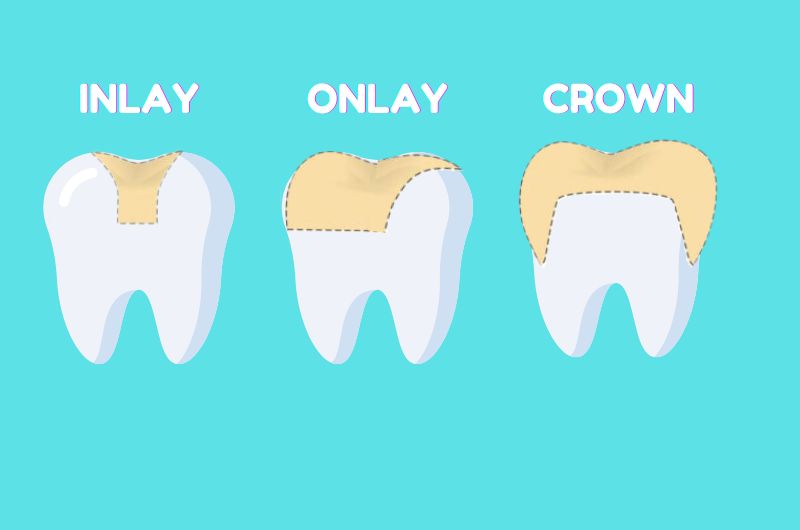 Which treatment option is preferred and when?