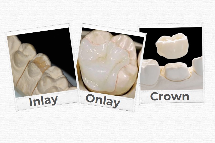 Inlay Onlay or Crown