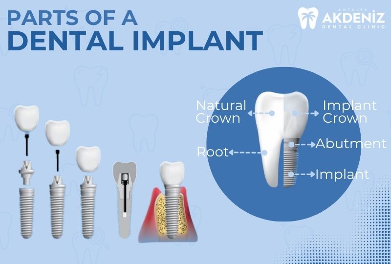 Dental Implant System