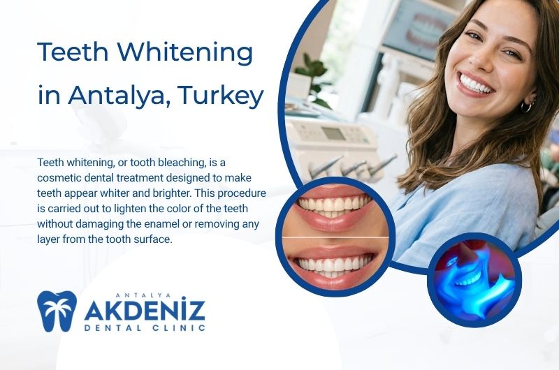 Teeth Whitening in Antalya, Turkey Teeth Whitening in Antalya, Turkey