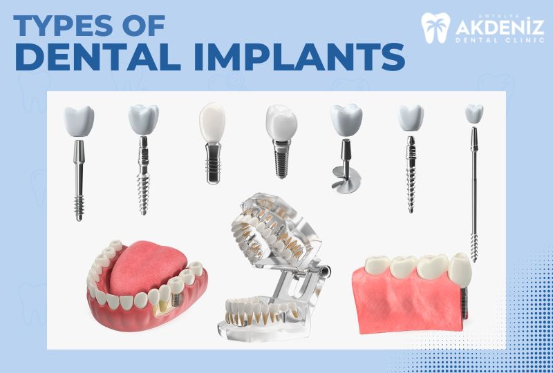 Dental Implant Types