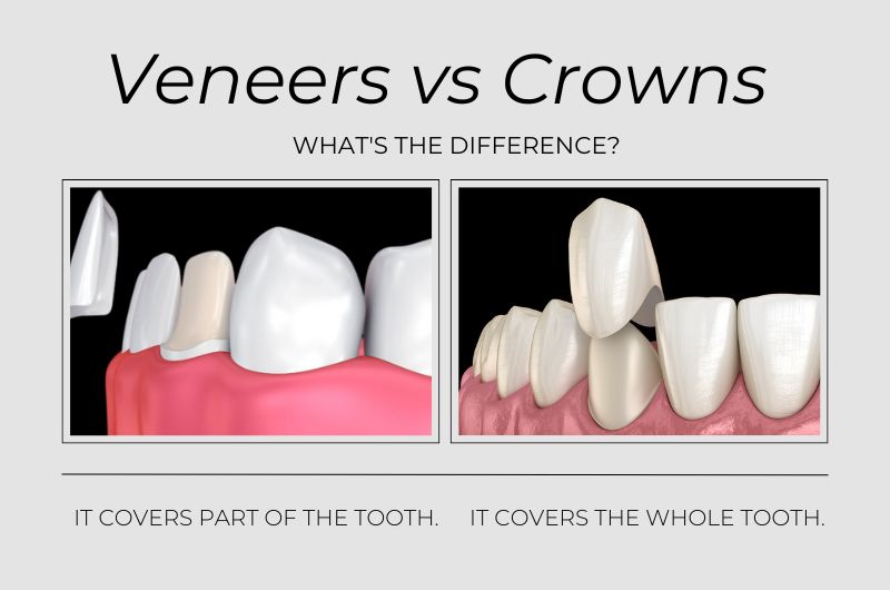 Veneers vs Crowns: What's the Difference?