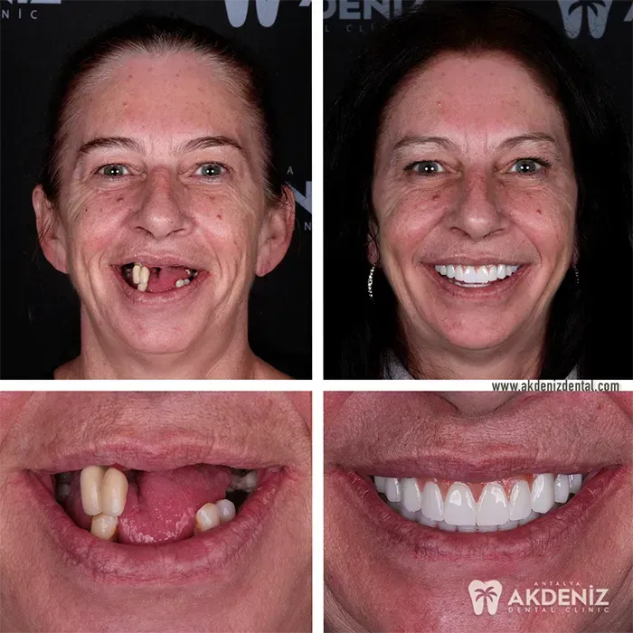 Happy patient before and after 1