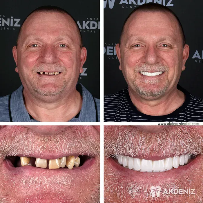 Happy patient before and after 10