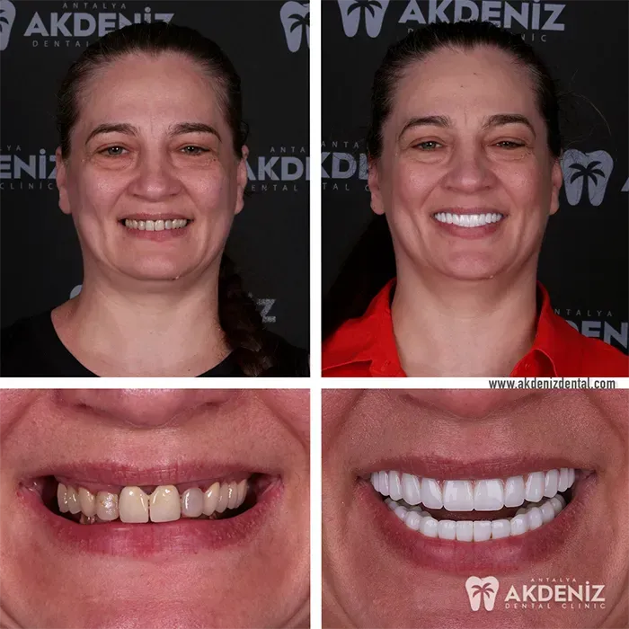 Happy patient before and after 11