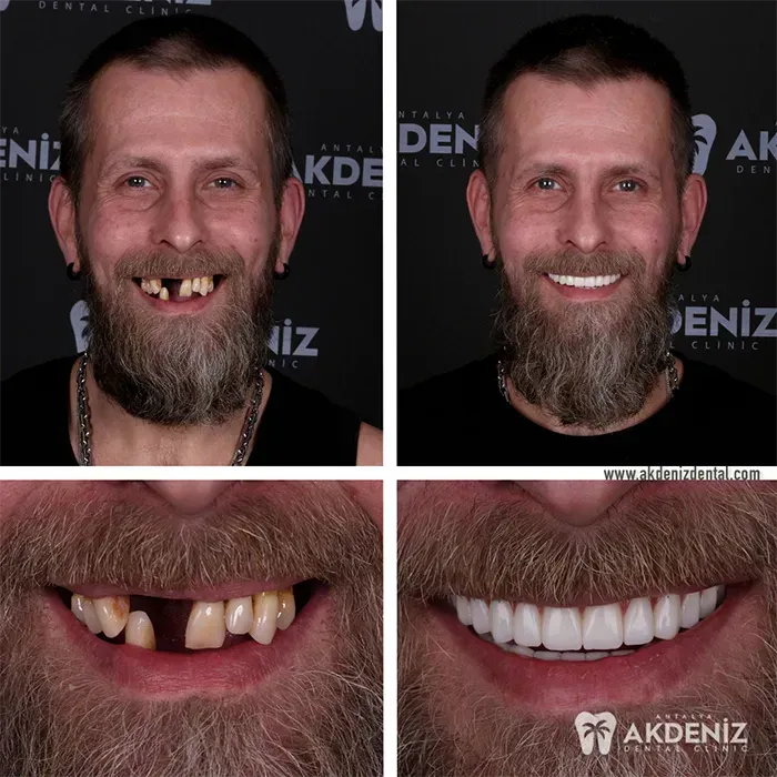 Happy patient before and after 12