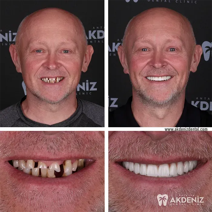 Happy patient before and after 13