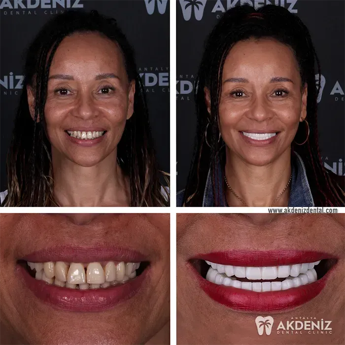 Happy patient before and after 14