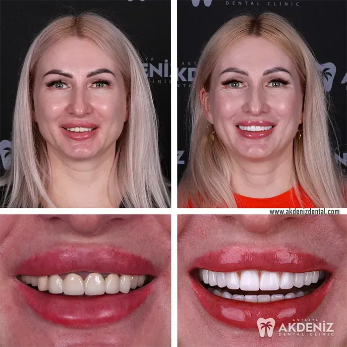 Happy patient before and after 15