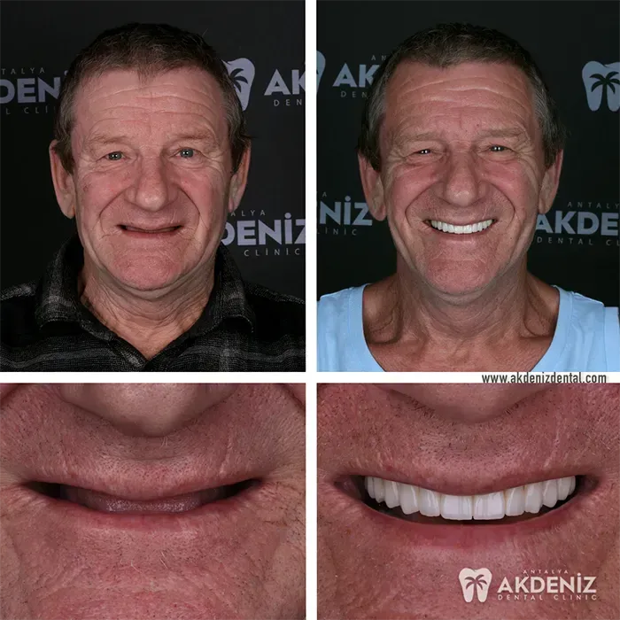 Happy patient before and after 16