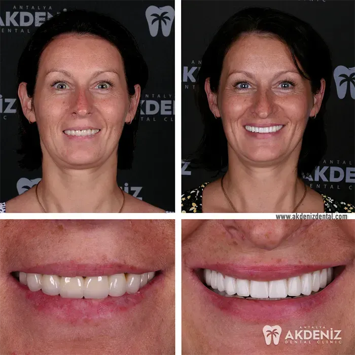 Happy patient before and after 17