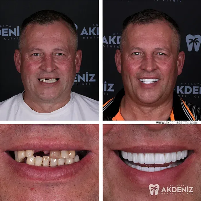 Happy patient before and after 18