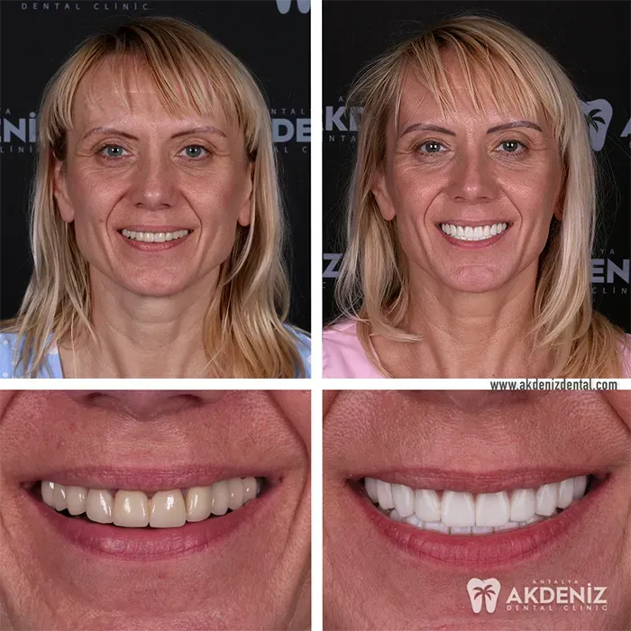 Happy patient before and after 19