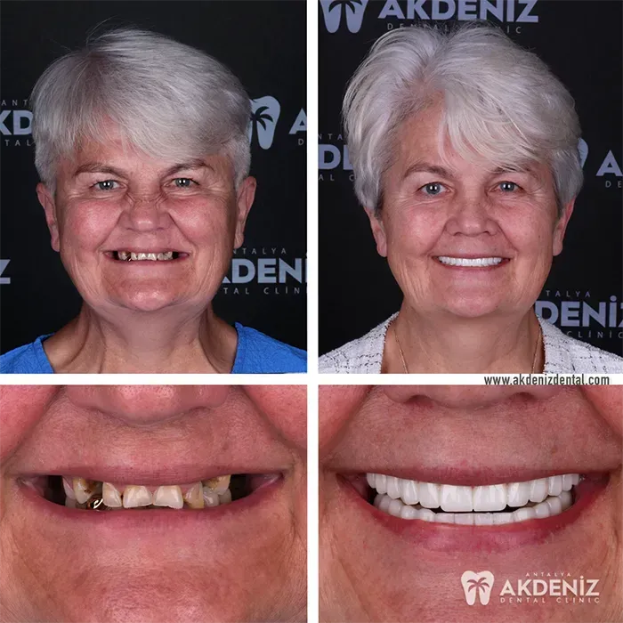 Happy patient before and after 2