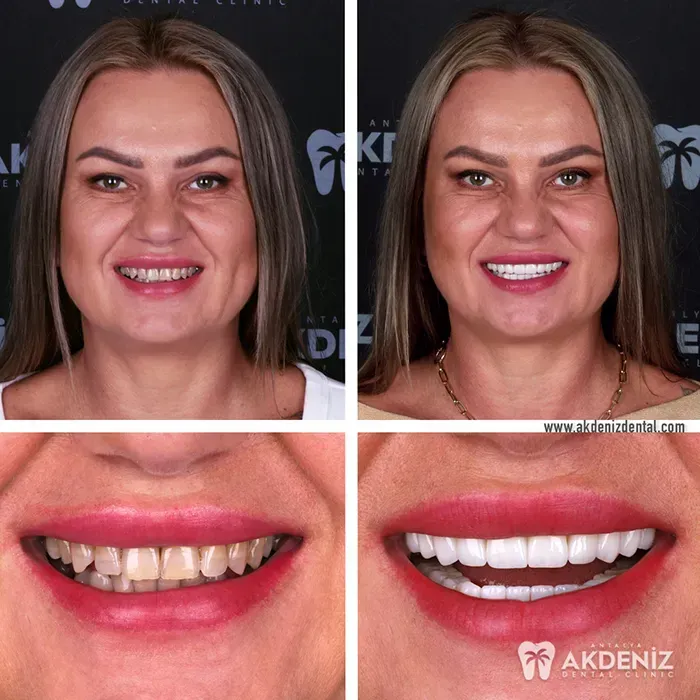 Happy patient before and after 20