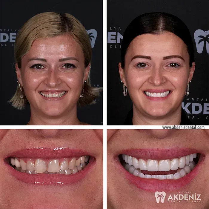 Happy patient before and after 3