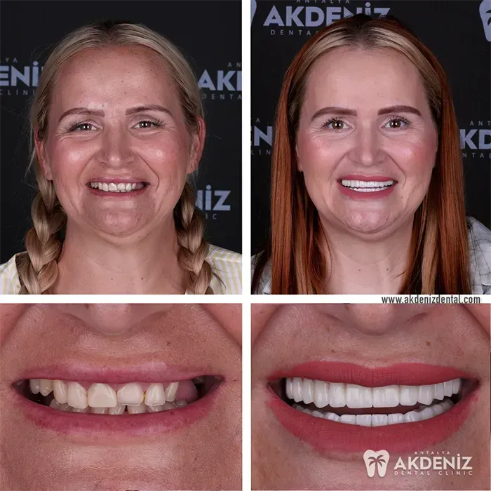 Happy patient before and after 4