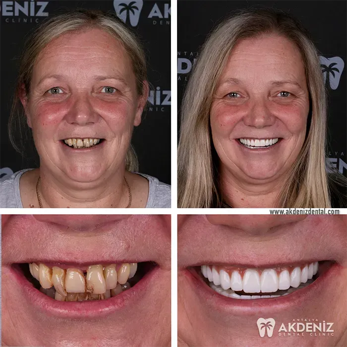 Happy patient before and after 5