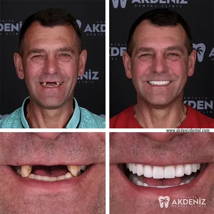 Happy patient before and after 6