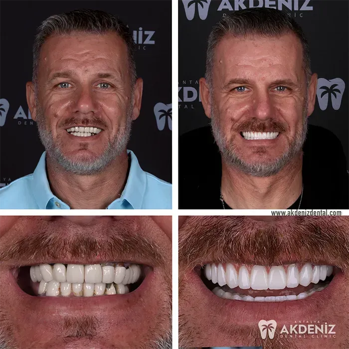 Happy patient before and after 7