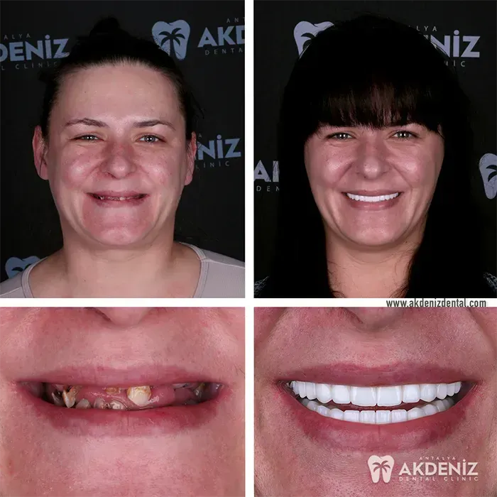 Happy patient before and after 9