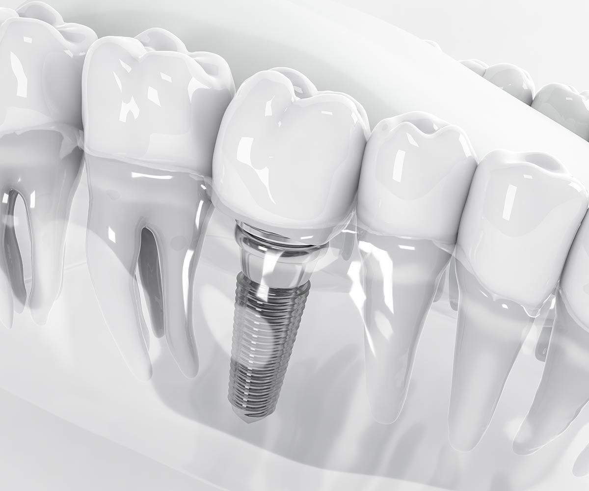 Dental Implant in Turkey