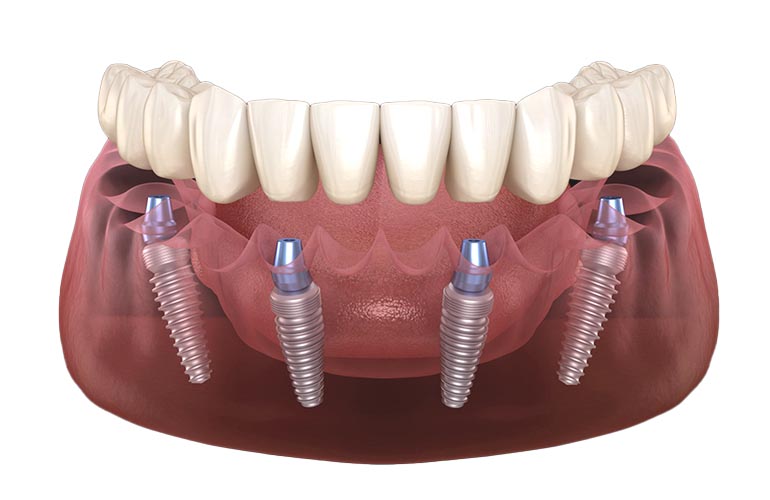 All-on-4 Dental Implants in Antalya