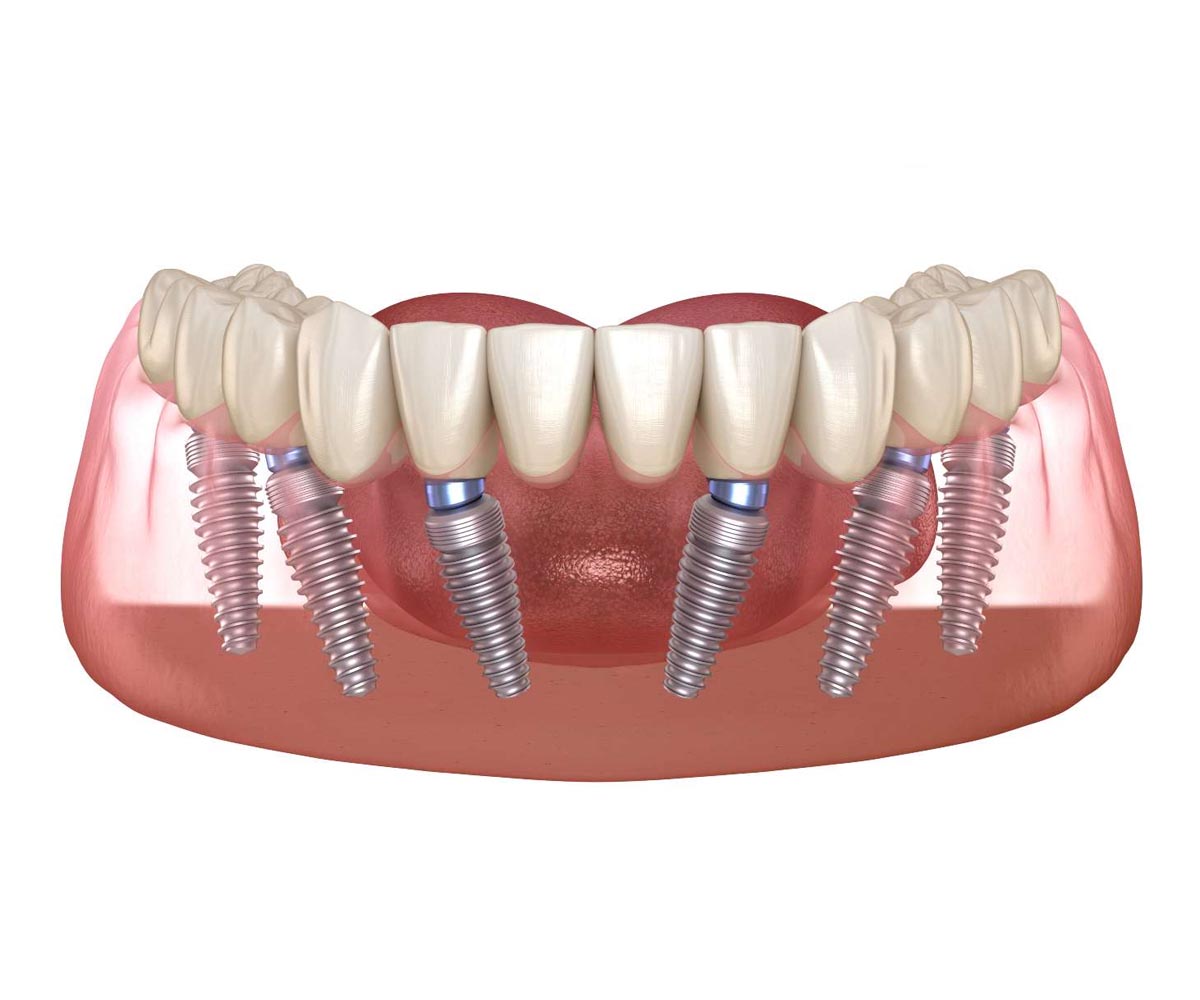 All-on-6 Dental Implants Antalya